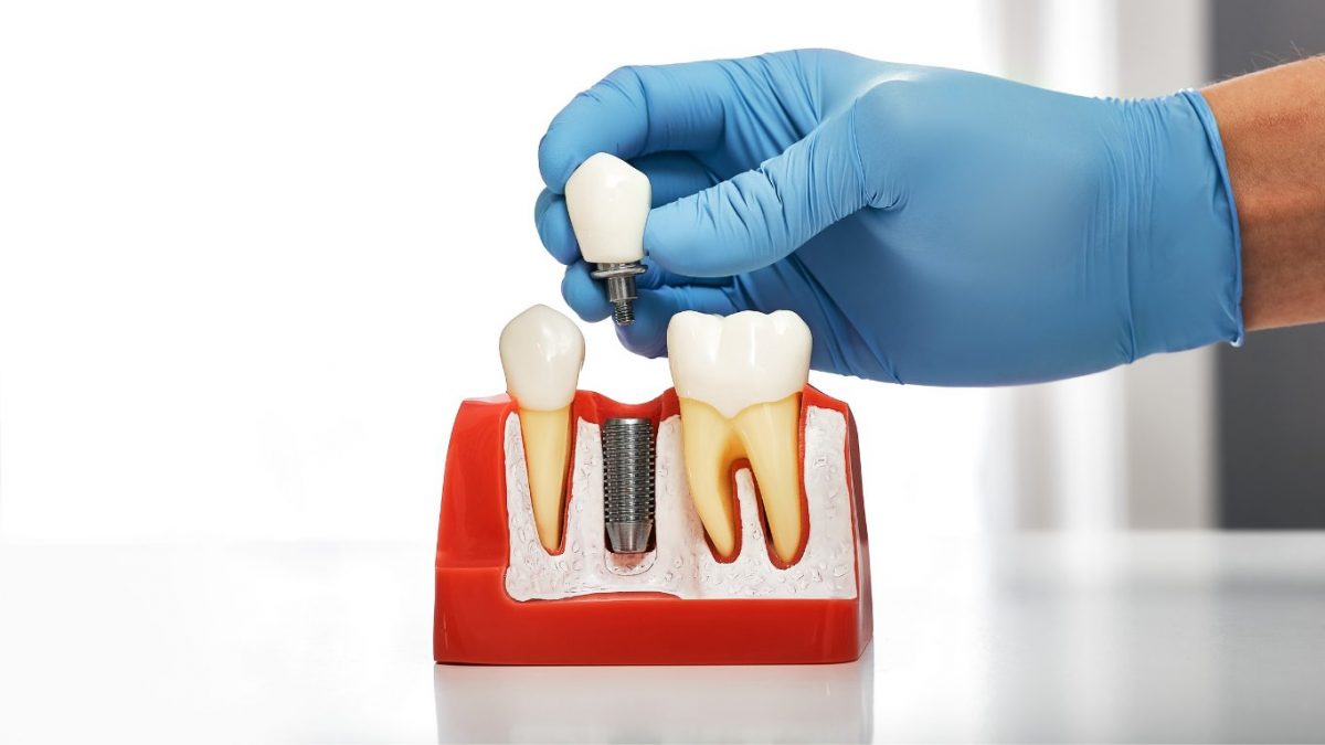 Dental Implants Vs Bridges All You Need To Know Right Here