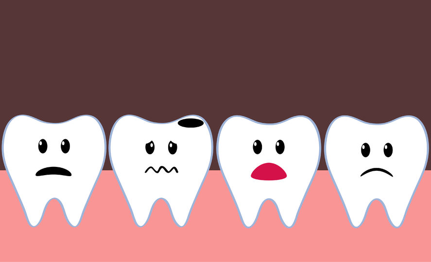 Chipped Teeth  Tooth Repair - Advanced Dentistry